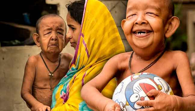 Bangladeshi boy with ‘old man’ illness baffles doctors