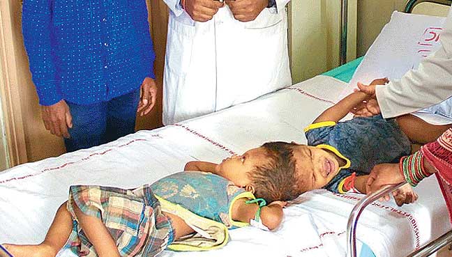 Indian doctors separate twins joined at the head