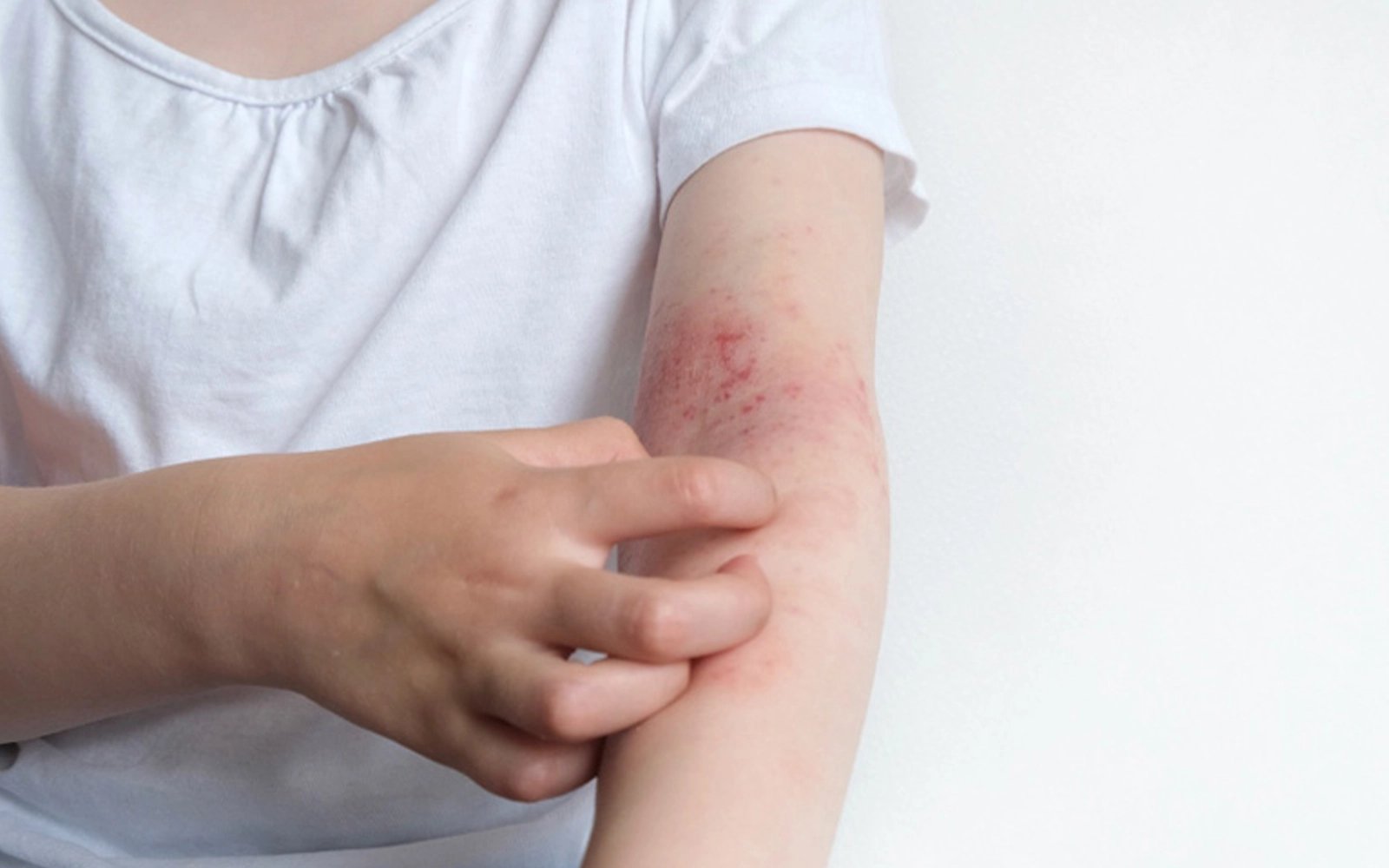 That quick eczema fix could be making things worse
