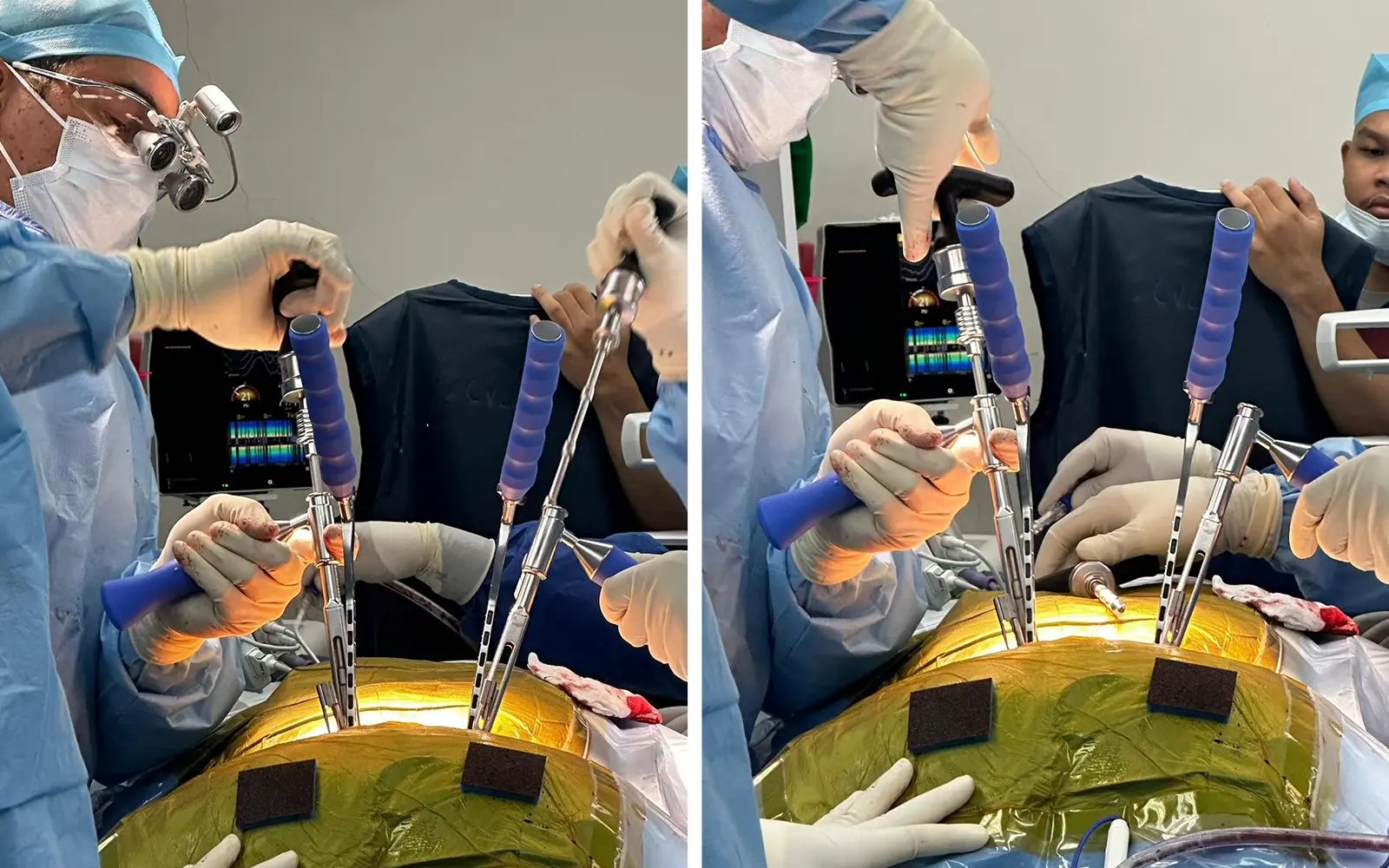 KPJ performs region’s first spinal procedure with cement screws